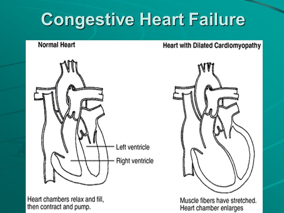 Congestive cardiac failure essay